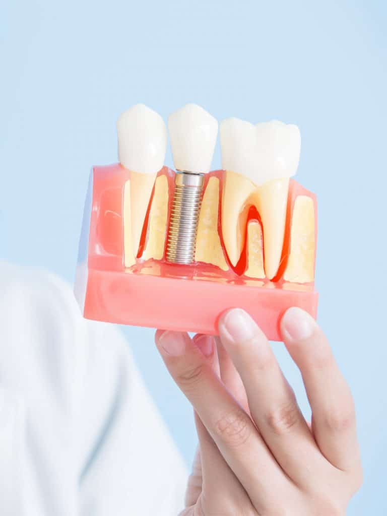 dental-implants