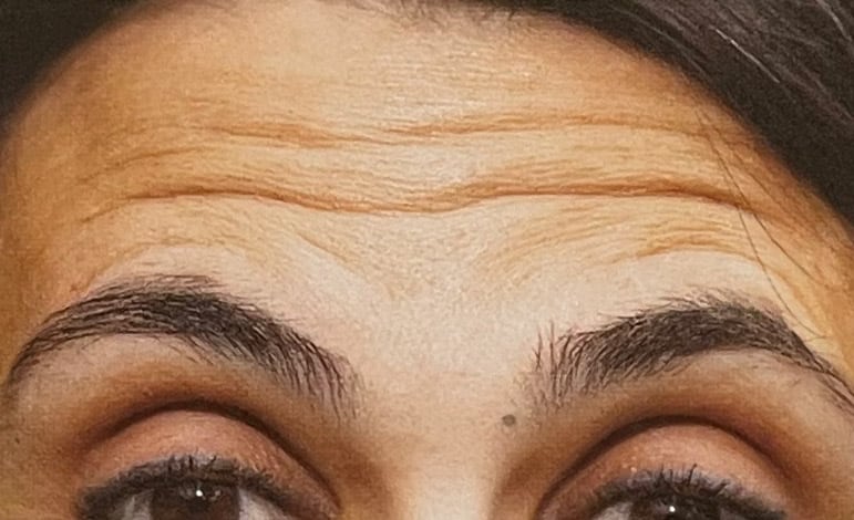 Forehead-lines