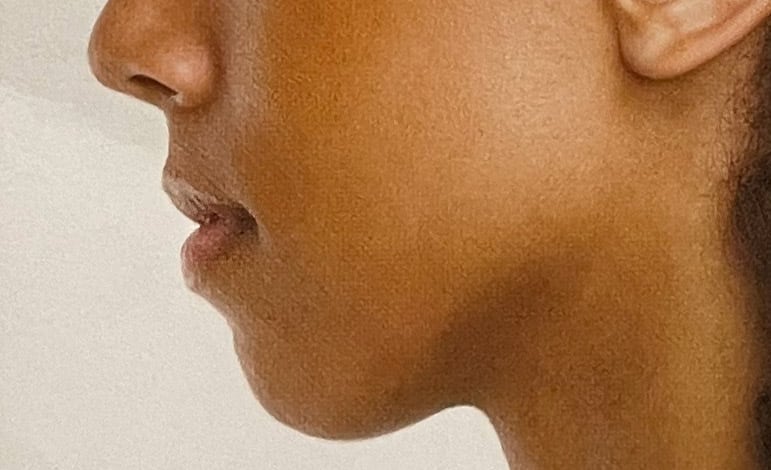 small chin/weak chin profile