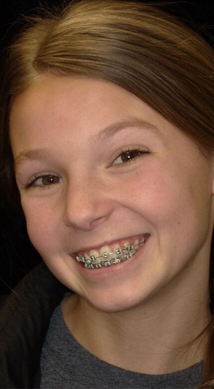 Young patient with orthodontic braces smiling - Cornerstone Dental Arts Knoxville TN