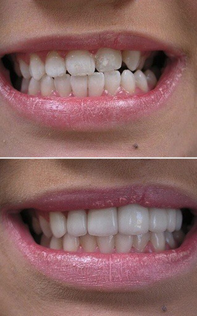 Before and after dental treatment results at Cornerstone Dental Arts in Knoxville, TN