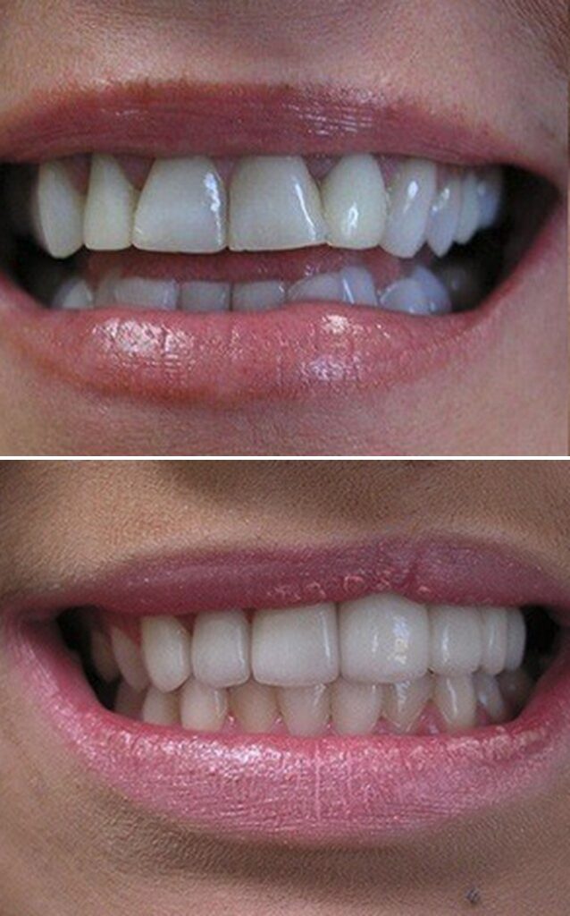 Before and after dental treatment results at Cornerstone Dental Arts in Knoxville, TN