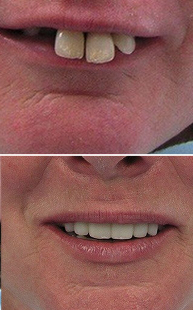 Before and after dental treatment results at Cornerstone Dental Arts in Knoxville, TN