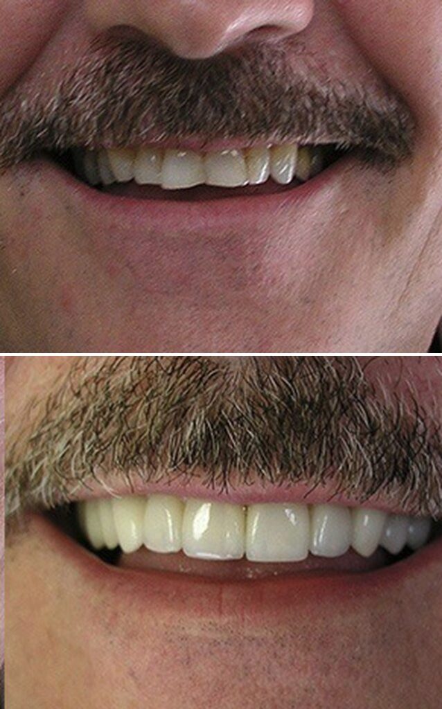 Before and after dental treatment results at Cornerstone Dental Arts in Knoxville, TN