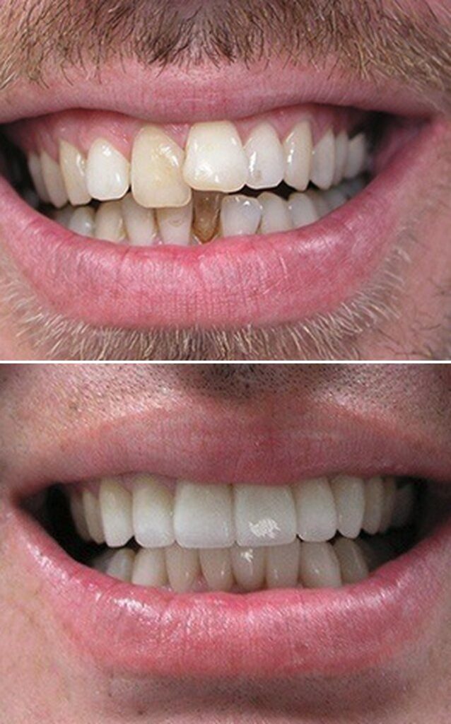 Before and after dental treatment results at Cornerstone Dental Arts in Knoxville, TN