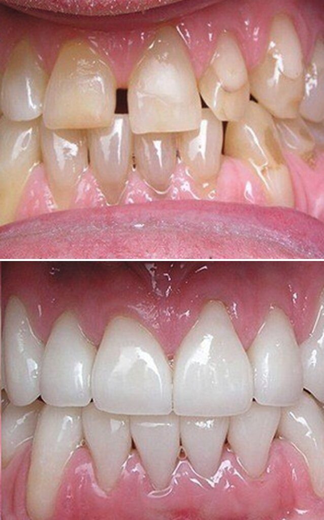 Before and after dental treatment results at Cornerstone Dental Arts in Knoxville, TN