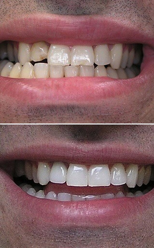Before and after dental treatment results at Cornerstone Dental Arts in Knoxville, TN