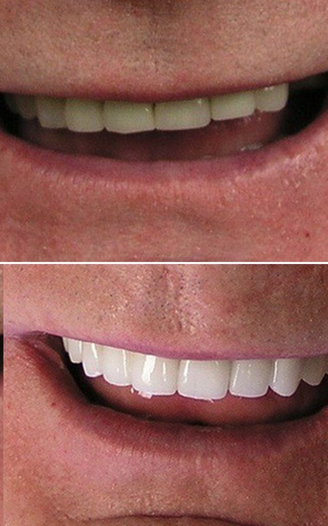 Before and after dental treatment results at Cornerstone Dental Arts in Knoxville, TN