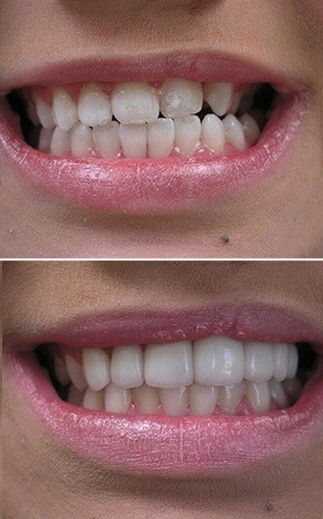 Before and after dental treatment results at Cornerstone Dental Arts in Knoxville, TN