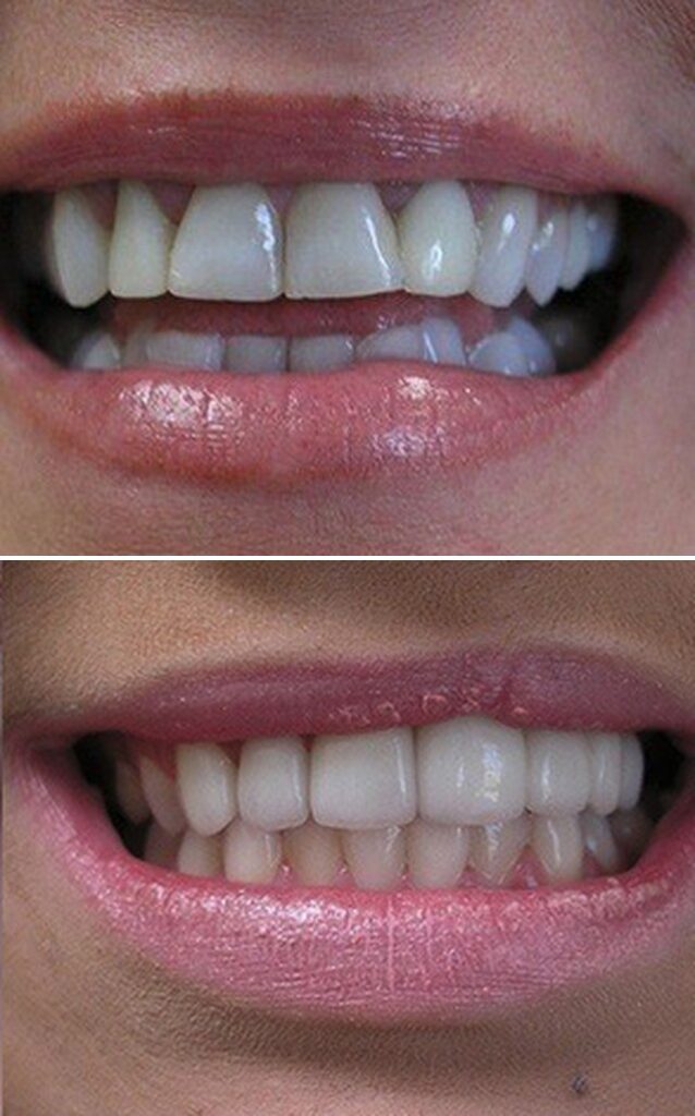 Before and after dental treatment results at Cornerstone Dental Arts in Knoxville, TN
